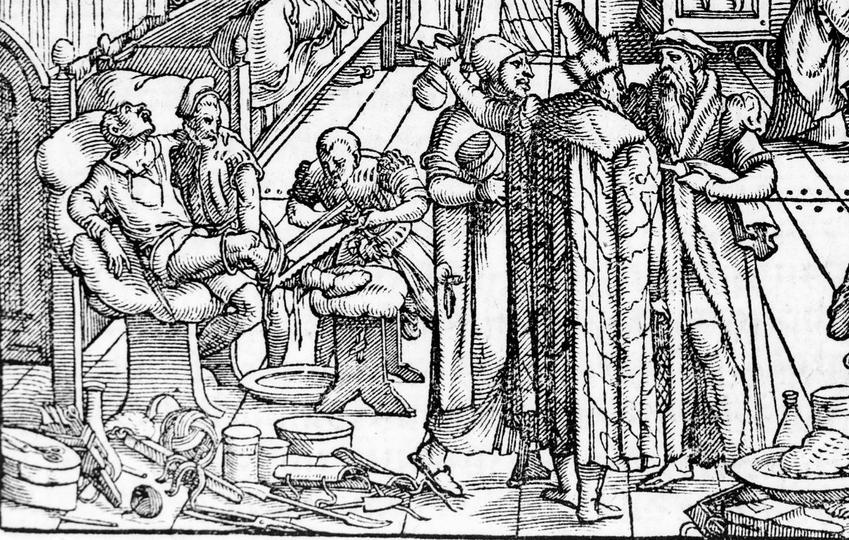 Chirurgie Renaissance : amputation d'après Paracelse