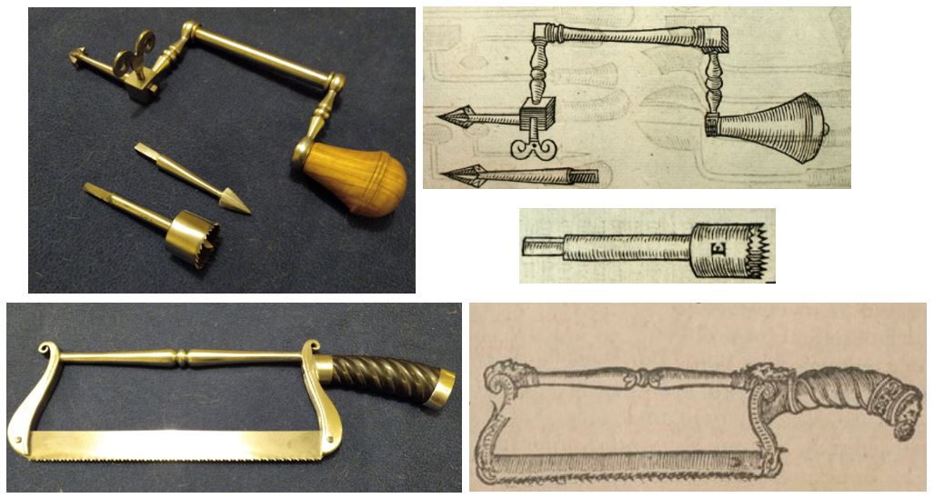 Reconstitution de matériel de trépanation et amputation d'Ambroise Paré